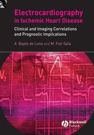 бесплатно читать книгу Electrocardiography in Ischemic Heart Disease автора Miquel Fiol-Sala